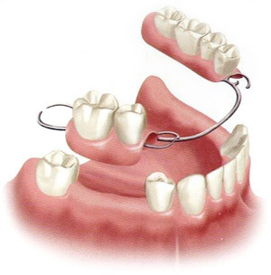 Nha-Khoa-Thien-Bao-Dental-Clinic-Removal-Denture-05