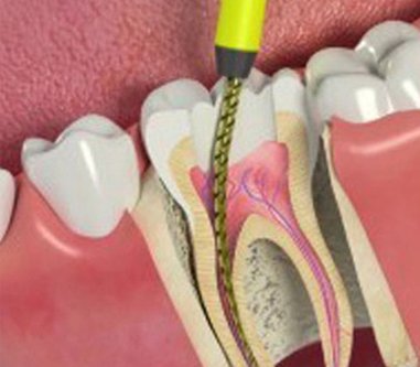 Nha-Khoa-Thien-Bao-Root-Canal-01