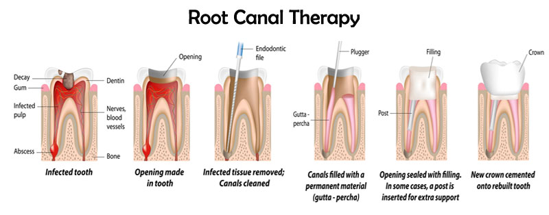 Nha-Khoa-Thien-Bao-Root-Canal-03