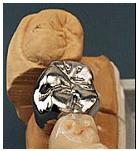 NhaKhoaThienBao-Aesthetic-Restoration-03