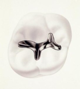 NhaKhoaThienBao-Dental-Fillings-04