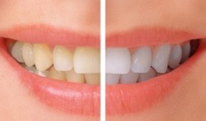 Teeth-Whitening-before-after-NhaKhoaThienBao