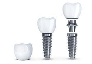 nha-khoa-thien-bao-dental-implant-02